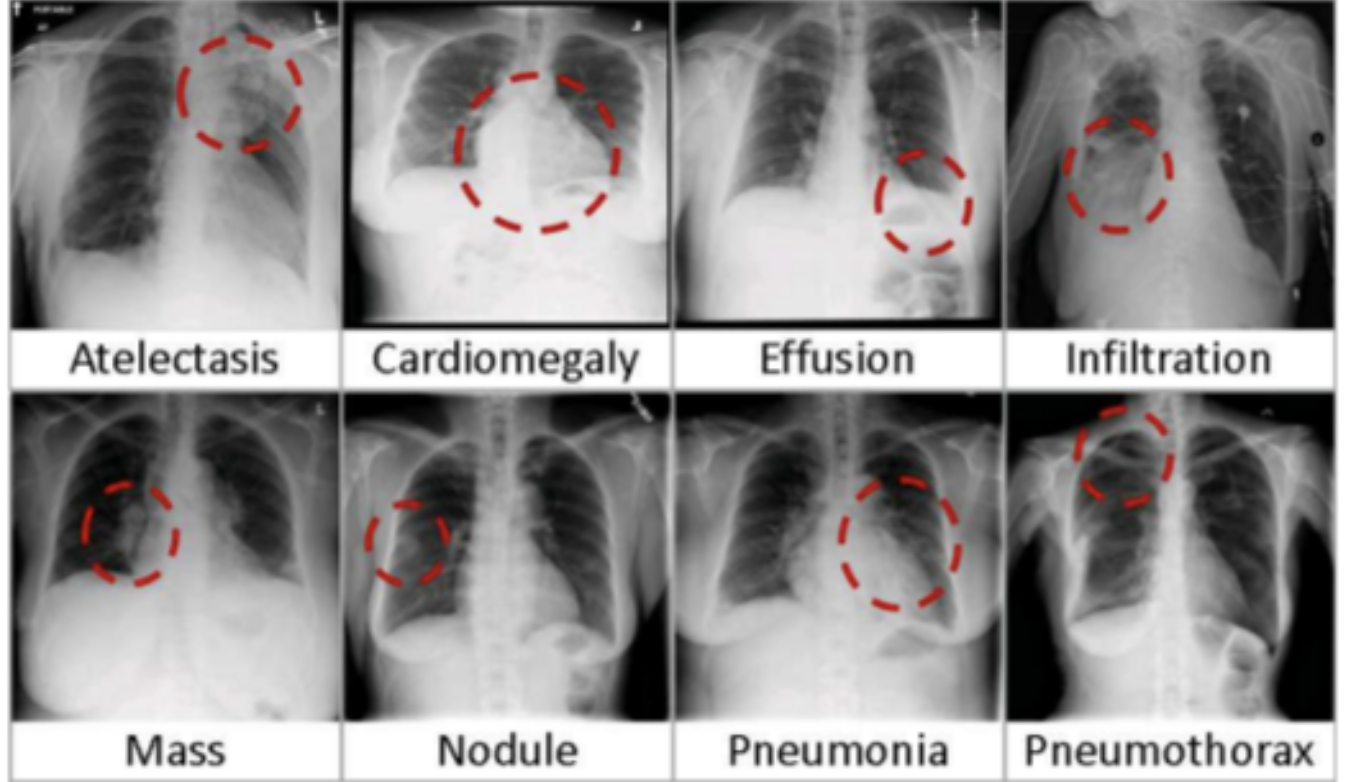 chest-disease-detection